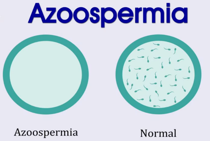 azoosperima